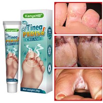 발톱 무좀약 연고 발톱치료 발냄새 제거 발가락 가려움 연고, 20ml, 2개