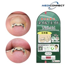 메디커넥트 네일에이드 내성발톱 교정기 내향성발톱 자가치료, 2개