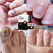 손발톱 무좀치료제 생강 진균 리페어에센스 발톱 케어제 발톱연화, 1개, 10ml, 1개