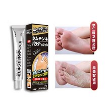 [당일배송] ANLAIHUI 발치료 가려움 악성체취 발냄새 발각질 완화 가려움 방지 살균 발 탈피 억제 연고, 15g, 1개