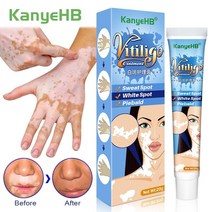 주름 노화 방지 제거 안티에이징 리프팅 미백 탄력 피부 페이스 크림 20g 초본 추출물 vitiligo 연고 백선 제거 화이트 스팟 제거 피부 화이트 스팟 백반증 질병 227, 1개