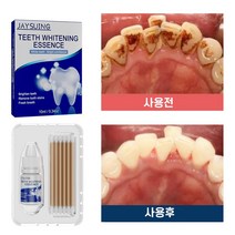 치아 미백 셀프 치아미백제 화이트닝겔 치아 얼룩 치석제거, 3개, 10ml