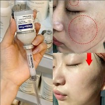 글루타치온 검버섯제거 앰플/굵은주름 모공 늘어진피부 리프팅/멜라논크림/얼굴 검버섯/검버섯제거/기미에좋은팩/기미치료/검버섯제거비용, 6세트+검버섯 마스크10