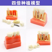 치아모형 인체모형도 치과기구 실리콘몰드 인체모형 양치교구 재료상, 4중 심기 의사-환자 커뮤니케이션 모델