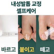 퍼펙토 내성발톱 치료 교정 팁 의료기기 세트, 16mm+16mm 2세트