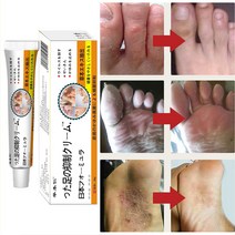 일본 무좀 연고 가려움증 억제 진균 발냄새 발각질 증상 완화 20g, 20ml, 1개