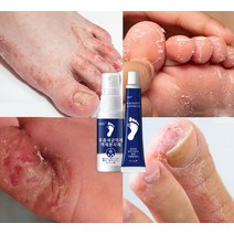 BT 무좀 스프레이 연고 약 발톱 각질 발바닥 발가락 간지럼 발 관리 풋케어, 30ml 15g, 1개, 1개