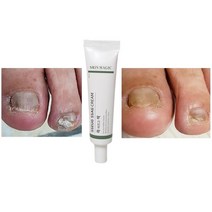 발톱 무좀 가려움 연고 30ml, 3+무좀비누