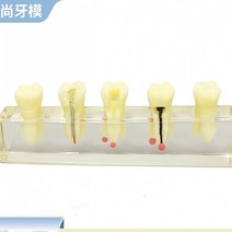 치아모형 모델 구강 교육 보조기 근관 치료 모델 임플란트 격리 된 병리학 의사 환자