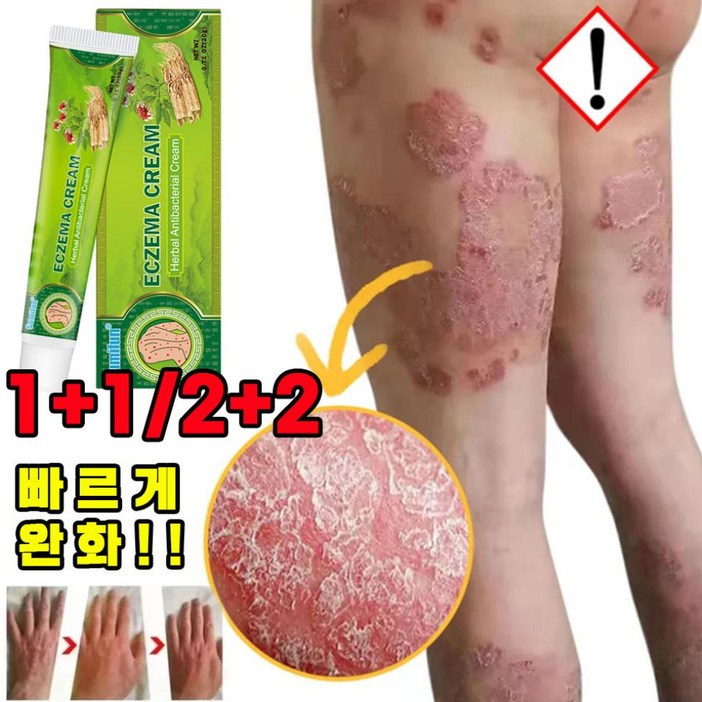 [당일출고] 1+1/2+2/3+3 피부 가려움증 건선 연고 모낭염 여드름 두드러기 습진 허브 연고 포장증정