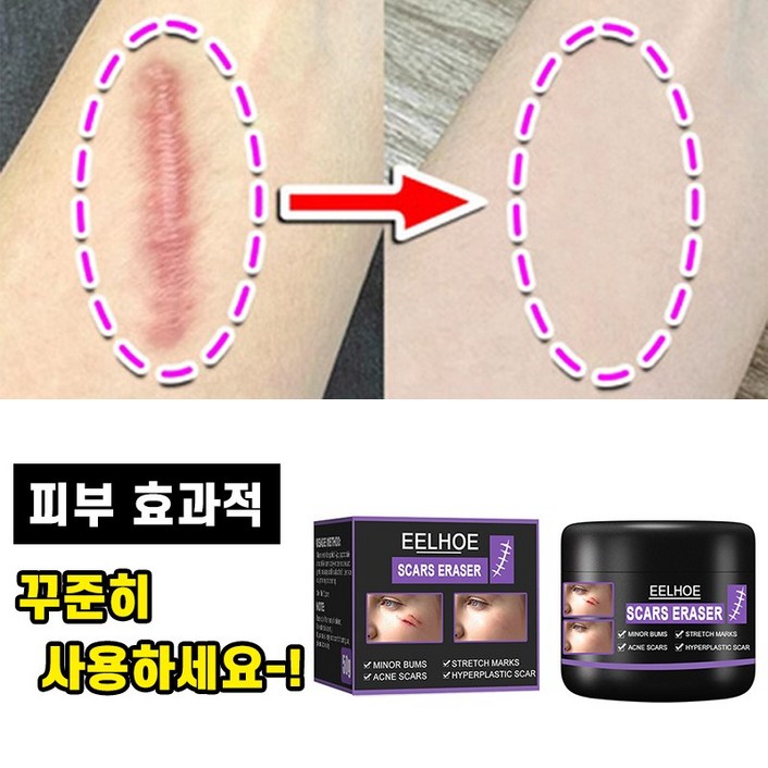 흉터제거연고 수술흉터제거 연고 화상상처 크림 여드름흉터 치료